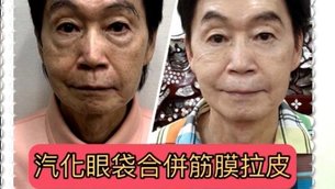 雷射汽化眼袋QA小學堂 - 